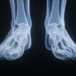 Custom Orthotics Extra Foot